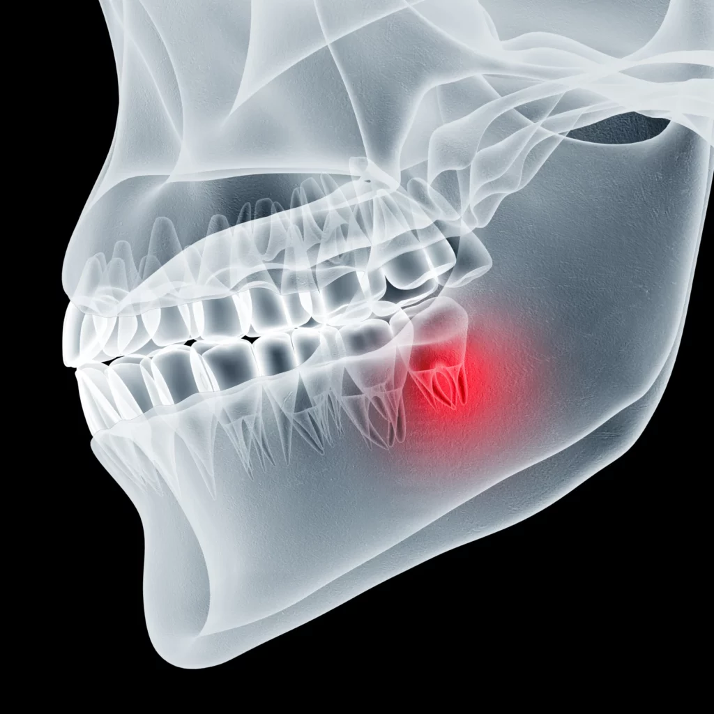 wisdom teeth removal in Wiggins, MS